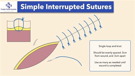 Wound Closure Techniques