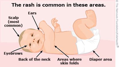 Cradle Cap (Seborrheic Dermatitis) in Infants (for Parents) | Nemours KidsHealth