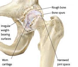 Pin on Osteoarthritis