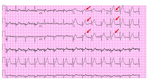 Atypical de Winter Presentation of Critical Left Anterior Descending ...