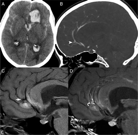 Ruptured intracranial aneurysm. A middle-aged patient presented with... | Download Scientific ...