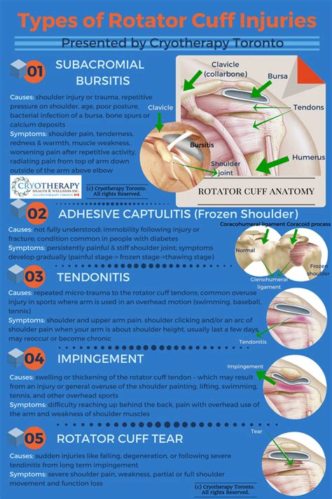 Rotator Cuff Pain Symptoms