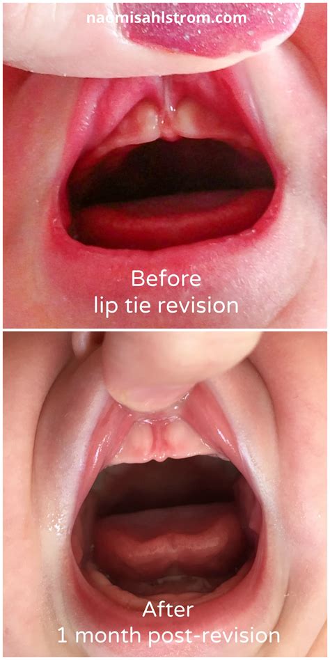 Lip & Tongue Tie in Newborns and Toddlers - Naomi Sahlstrom