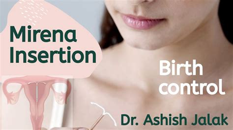 MIRENA INSERTION PROCEDURE STEPS │IUD BIRTH CONTROL│IN MARATHI BY DR. ASHISH JALAK, BARAMATI ...