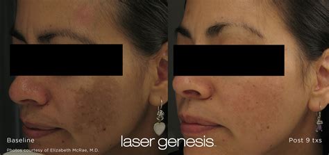 Laser Genesis New York, NY | Spring Street Dermatology