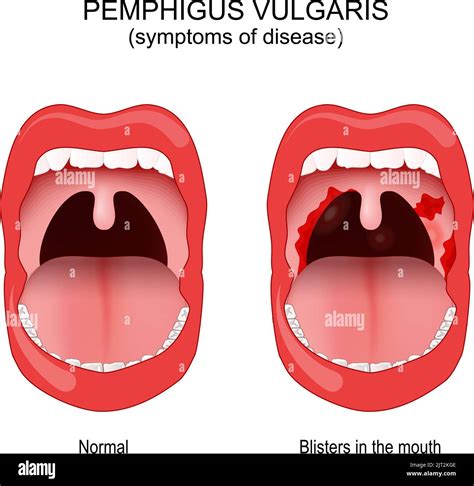 Pemphigus vulgaris Cut Out Stock Images & Pictures - Alamy