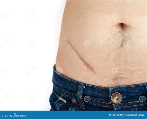 Closeup of Man Showing the Stomach with a Scar from Appendicitis ...