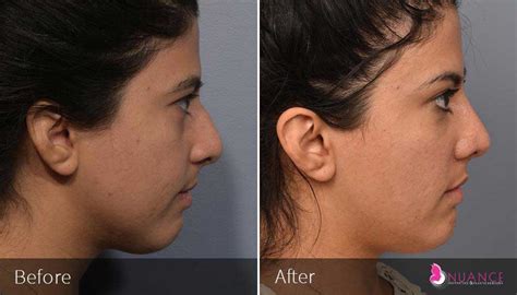 Chin Implant Surgery | Chin Augmentation in Las Vegas, NV