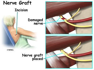 Quadrilateral Space Syndrome | eOrthopod.com