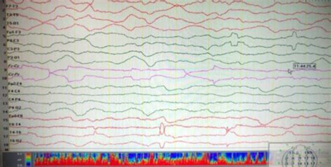 EEG of the case showing severe diffuse encephalopathy. | Download ...