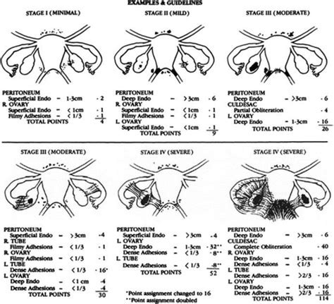 Classification of Endometriosis - Indian Center for Endometriosis (ICE)