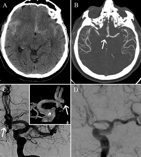 Brain Aneurysm Mri : 4 Intracranial Aneurysms Radiology Key - A brain aneurysm can result from a ...