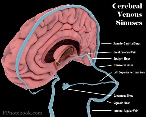 Sigmoid Sinus