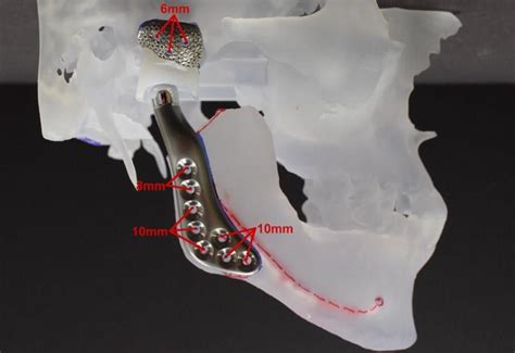 TMJ Replacement – Seattle Jaw Surgery