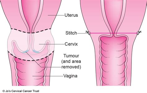 Having a trachelectomy | Jo's Cervical Cancer Trust