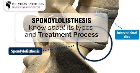 Spondylolisthesis Decompression Treatment | Spine Surgeon In Gurgaon