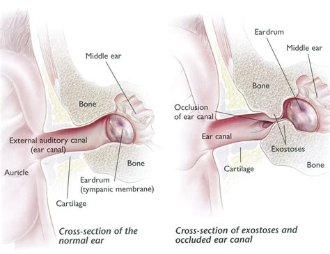 Exostoses Surfer's Ear - Dr Bridget Clancy | ENT Surgeon