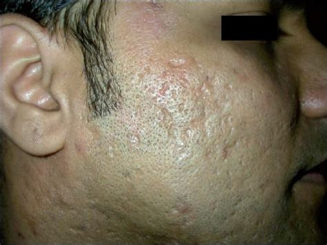 Acne Conglobata Scars