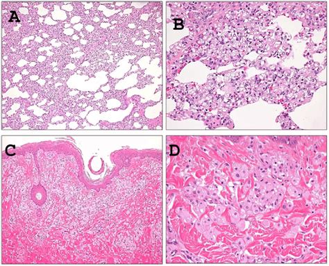 Histological analyses of mobilization of foamy macrophages in the lung ...