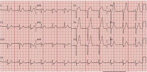 Dr. Smith's ECG Blog: HyperKalemia with Cardiac Arrest. Peaked T waves: Hyperacute (STEMI) vs ...