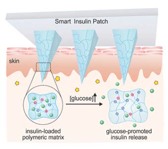 Insulin Patch Could Provide Cheap, Simple, and Effective “Cure” for T1D ...