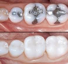 Silver & Composite Dental Fillings 16148 | FAQ | Hermitage Dentist