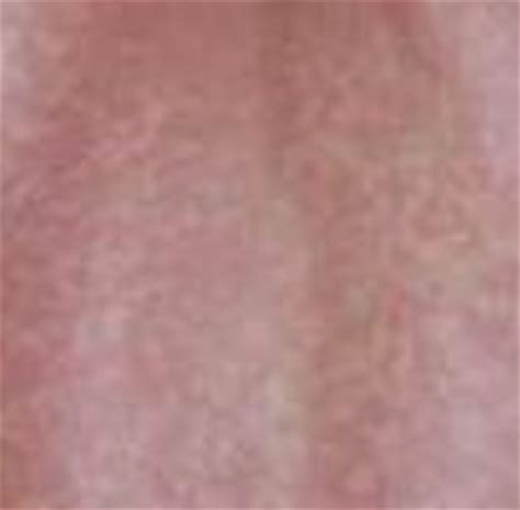 Lamictal Rash - Pictures, Symptoms, Treatment | Health Momma