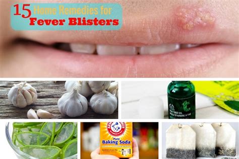 15 Home Remedies for Fever Blisters