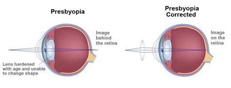 Presbyopia Causes - Monterey, CA