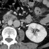 Unusual Ovarian Vein Thrombosis Associated with Urinary Tract Infection: A Case Report - Journal ...