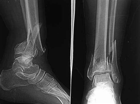 Pilon Fracture Classification Radiology