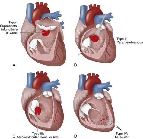 Congenital Cardiac Surgery | Clinical Gate