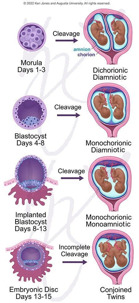 Illustration of Monozygotic Twins - Chorion and Amnion Differences