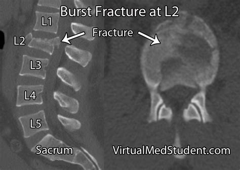 Thoracolumbar Burst Fractures Orthotics And Prosthetics, X-ray Images ...