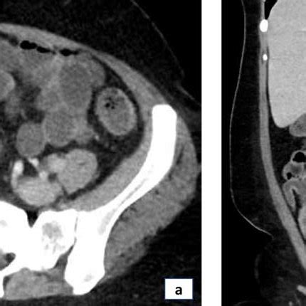 Ileocolic resection showing an edematous terminal ileum with ...