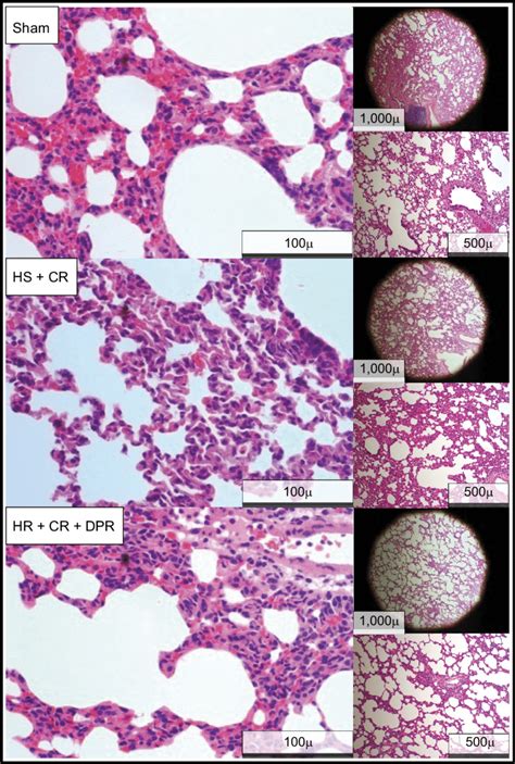 Lung histopathology slides. Lung histopathology is shown in the ...