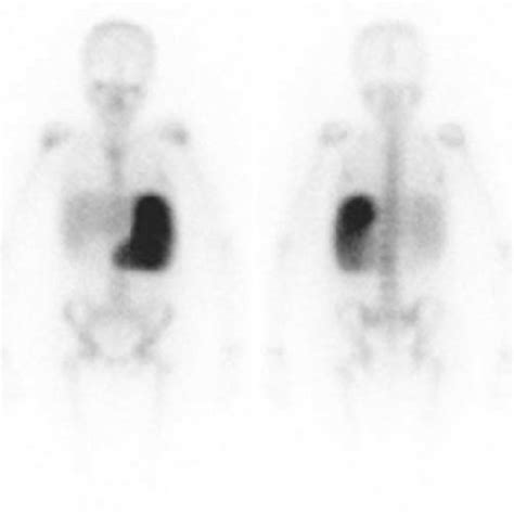 Gallium scan (Ga 67) demonstrates diffuse splenic uptake. | Download Scientific Diagram