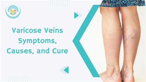 Varicose Veins Symptoms, Causes, and Cure