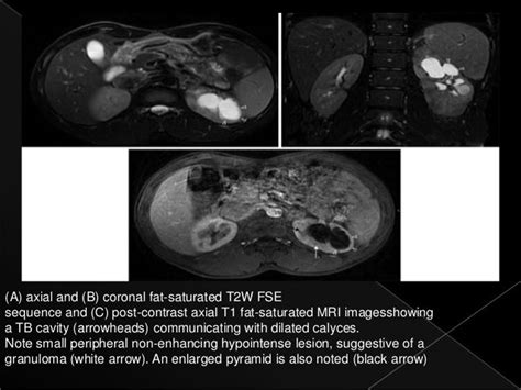 Renal tuberculosis radiology