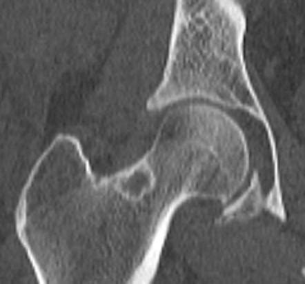 Synovial herniation pit | Radiology Reference Article | Radiopaedia.org