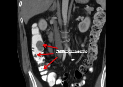 Colon polyps CT scan - wikidoc