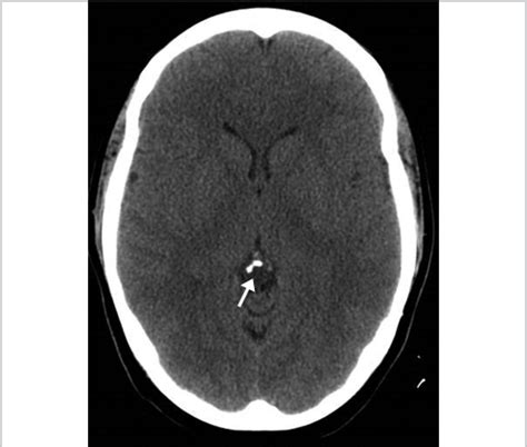 Pineal Gland Calcification