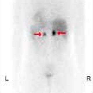 MIBg scan shows the increased uptake in both adrenal glands consistent... | Download Scientific ...