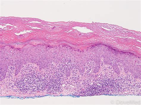 Lichen Planus Histology Sawtooth