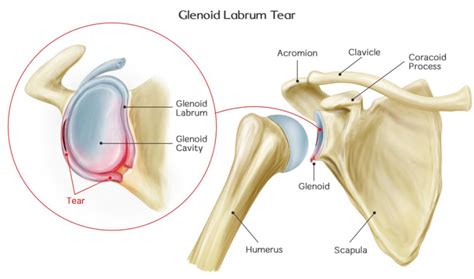 Labrum Tear Shoulder Treatment - Specialized Physical Therapy