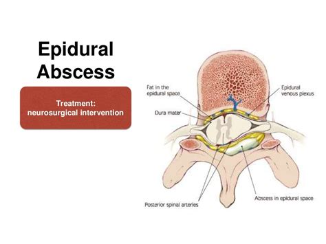 COMPLICATIONS OF SPINAL & EPIDURAL ANAESTHESIA