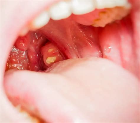 White spots on tonsils | causes, symptoms, treatment, pictures