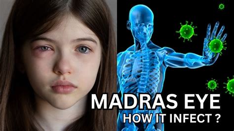 WHAT IS MADRAS EYE ? \ SYMPTOMS OF MADRAS EYE #madraseye #chennai # ...