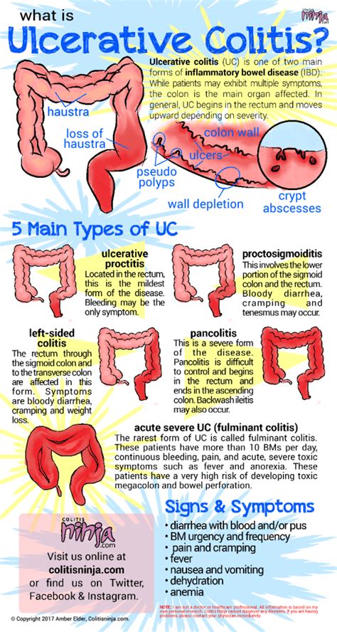 The Ins and Outs of Ulcerative Colitis | Colitis Ninja