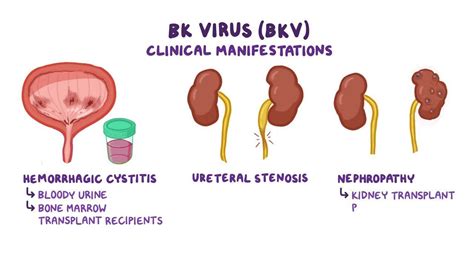 BK virus (Hemorrhagic cystitis) - Osmosis